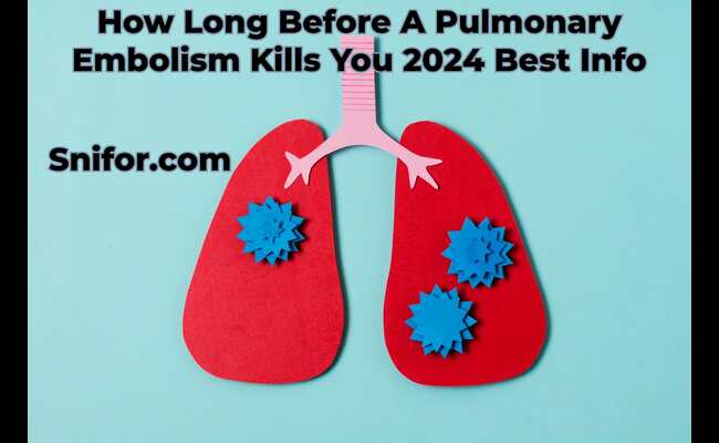How Long Before A Pulmonary Embolism Kills You 2024 Best Info
